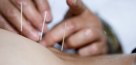 Mezi léčebné metody vycházející z tradiční čínské medicíny patří i akupunktura.